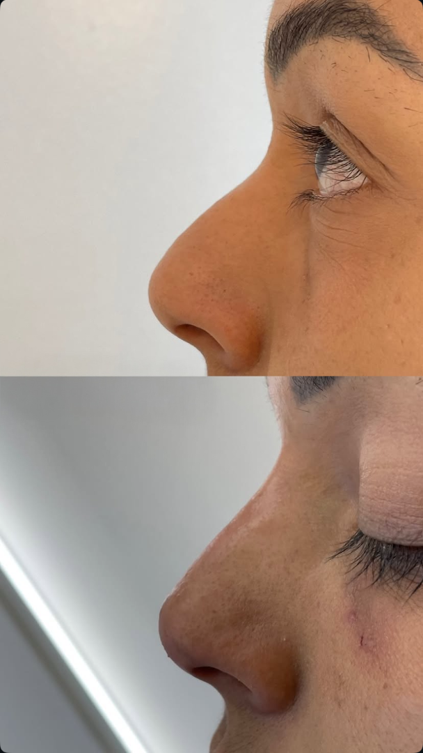 Antes e depois de rinomodelação perfil nasal mais alinhado, resultado natural