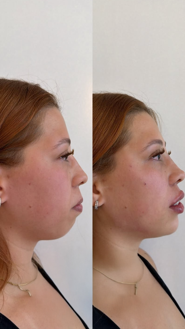 Antes e depois de definição de mandíbula e mento contorno mais marcado